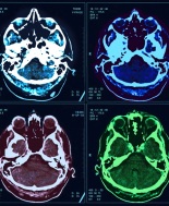 Parkinson, ricerca smonta ipotesi ruolo della proteina prionica nel danno cognitivo